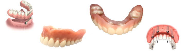 自費治療入れ歯