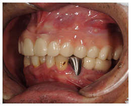 ジルコニア義歯装着例２
