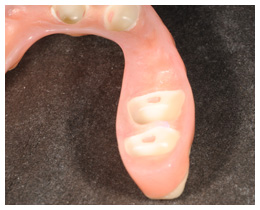 固定装置PFTシステム拡大