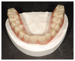 ジルコニア一体型義歯装着