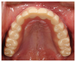 ジルコニア義歯装着写真１
